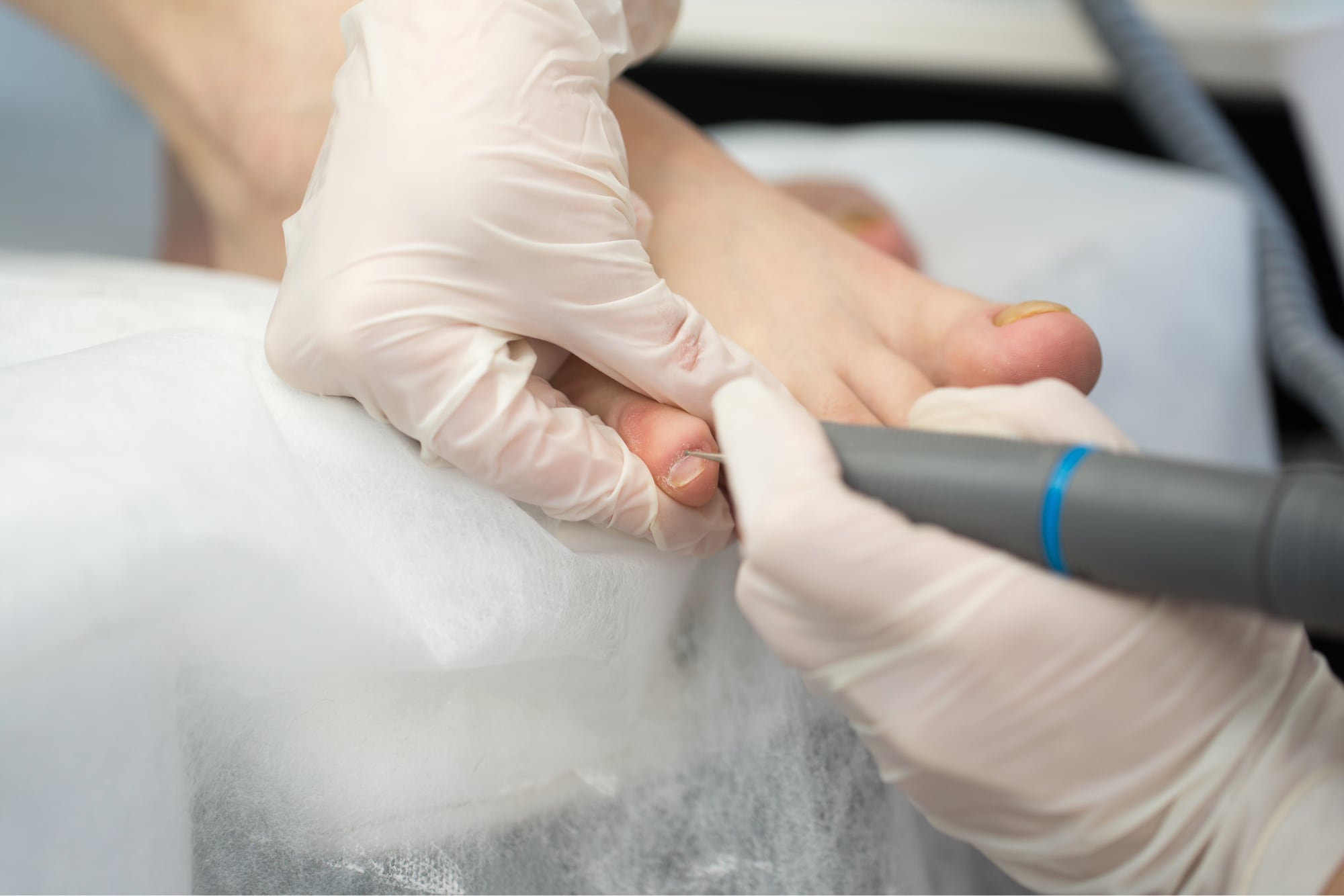 Nail Surgery - Infinite Podiatry & Physio