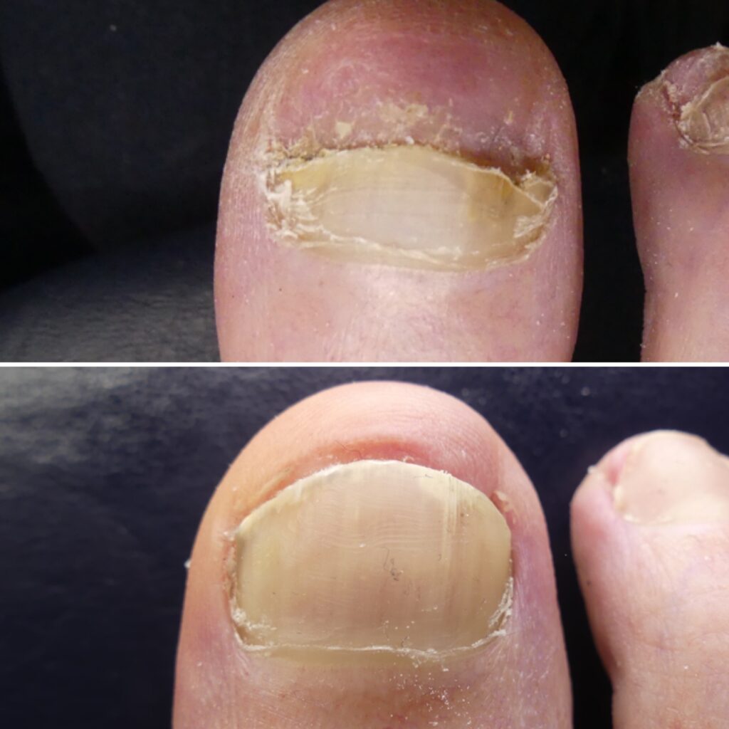 Lunula Before After